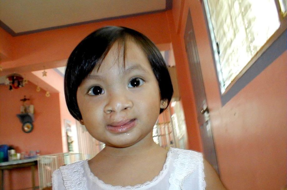 Reports on Free Cleft Surgery for 400 Filipino Children GlobalGiving