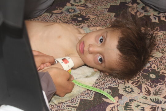 Malnutrition children U5yr &  PLW in Yemen
