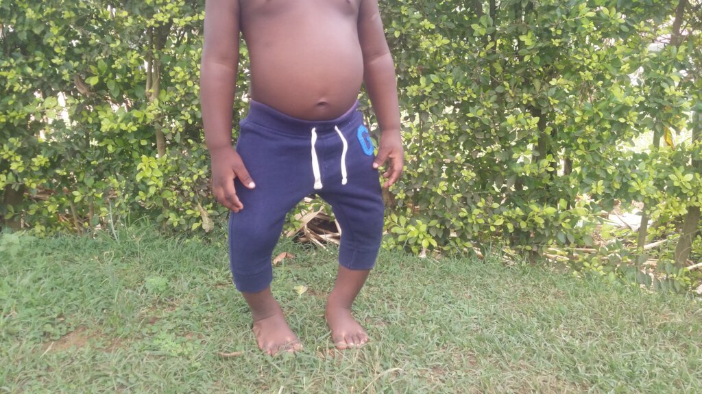 Donate to Help correct baby Eli's bowed legs in Uganda GlobalGiving